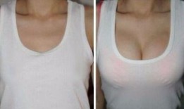 关于隆胸爆料的视频素材,视频素材揭示整形行业内幕